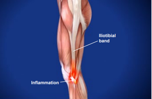 Iliotibial Band Syndrome Treatment Doctors (Knee Specialists) Brooklyn